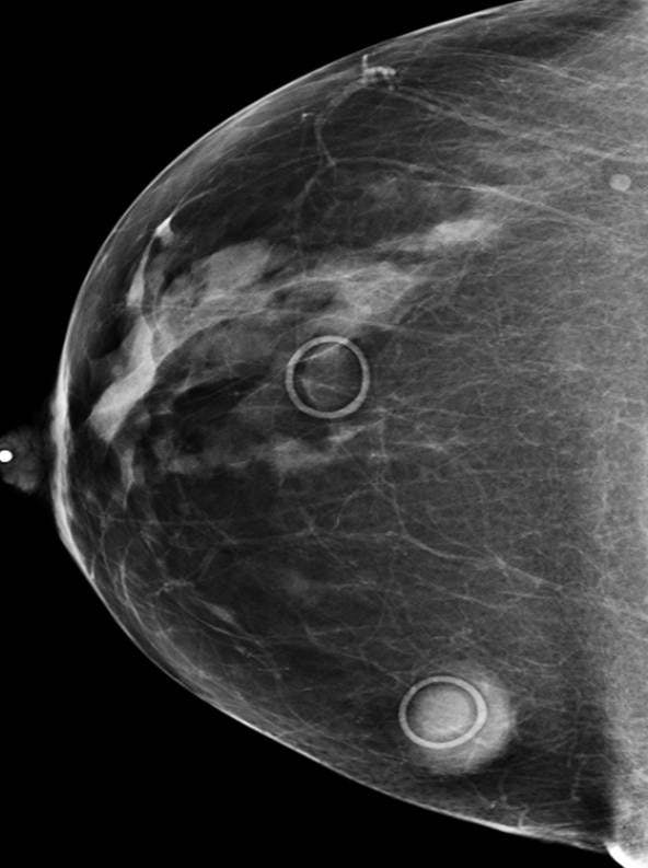 Image IQ: 47-year-old with Multiple Moles, Screening Mammogram