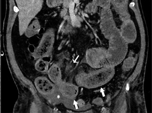 Figure 1b: Axial (A) and coronal (B) CT of the abdomen and pelvis with IV contrast in a 57-year-old man with a high clinical suspicion for bowel ischemia. There was generalized small bowel distension and segmental thickening (arrows), with adjacent mesenteric congestion (thin arrow in B), and a small volume of ascites (* in B). Findings are nonspecific but suggestive of early ischemia or infection. Courtesy: Radiology
