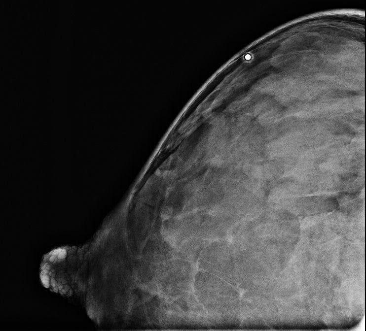 Image IQ: 30-year-old, Breastfeeding, with Nontender Breast Lump