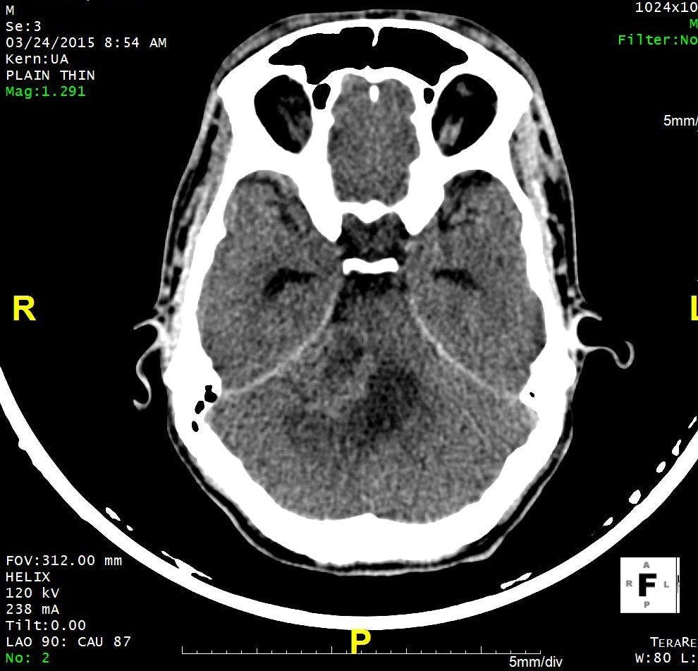 Image IQ: 28-year-old, Sensorineural Hearing Loss