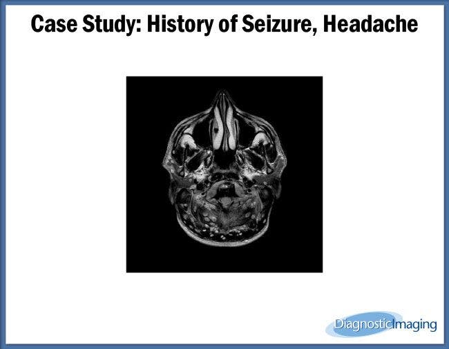 History of Seizure, Headache