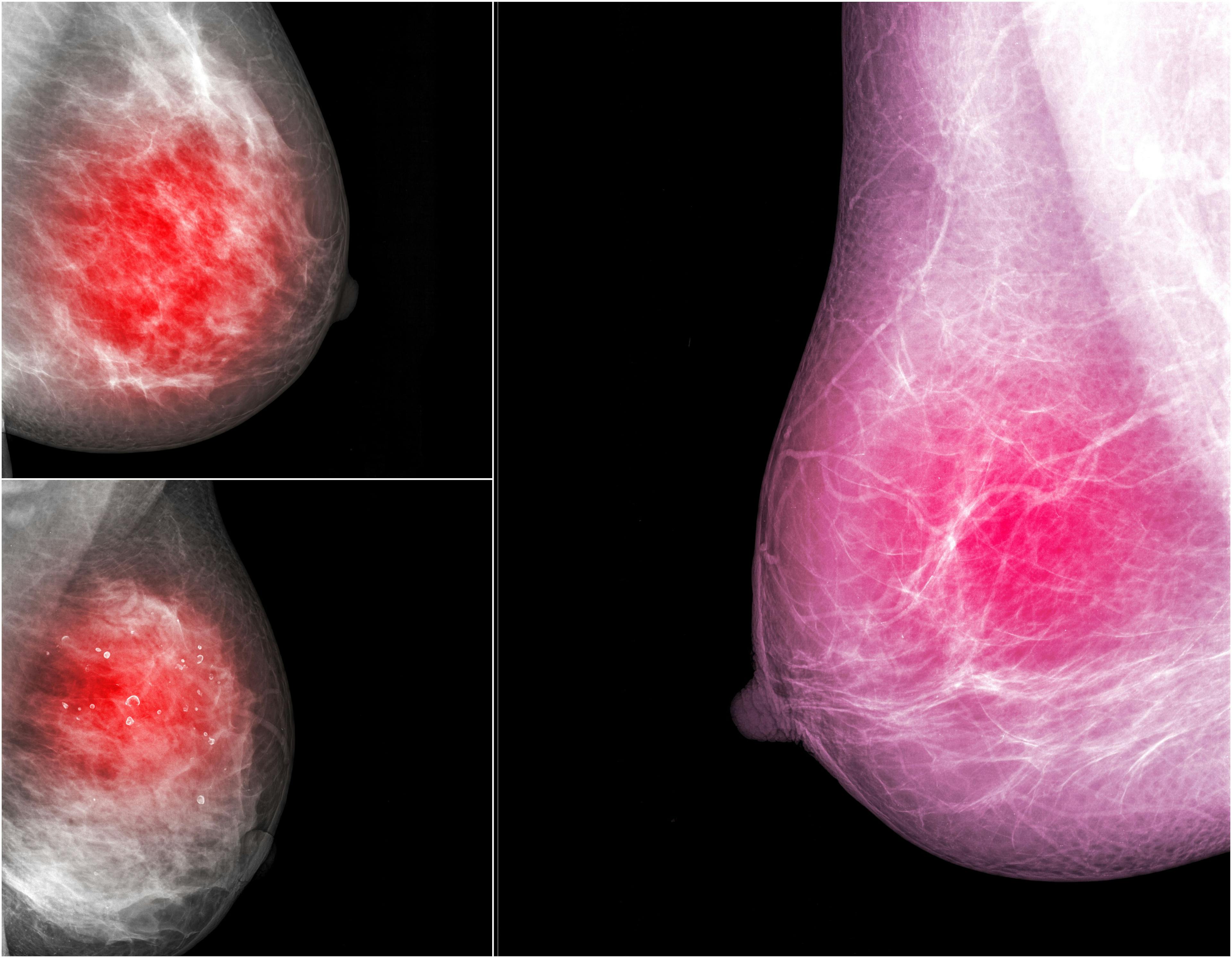 Diffusion-Weighted Imaging Helps Detect Breast Cancer in Dense Breasts 