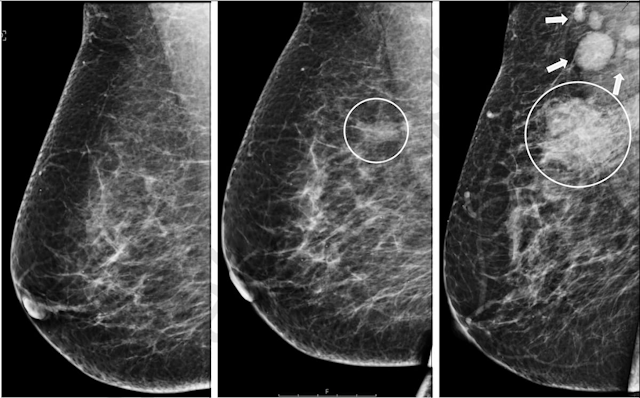 New Research Shows Consequences of Delayed Diagnosis in Mammography Screening