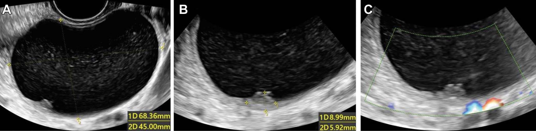 Can Deep Learning Ultrasound Assessment be a Viable Option for Diagnosing Ovarian Cancer?