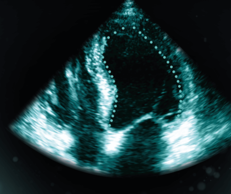 Adjunctive AI Software for Cardiac Ultrasound Gets FDA Nod