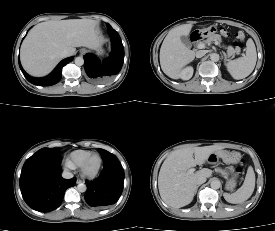 Study Shows Less Than 50 Percent Adherence to Follow-Up After Positive CT Findings for Lung Cancer