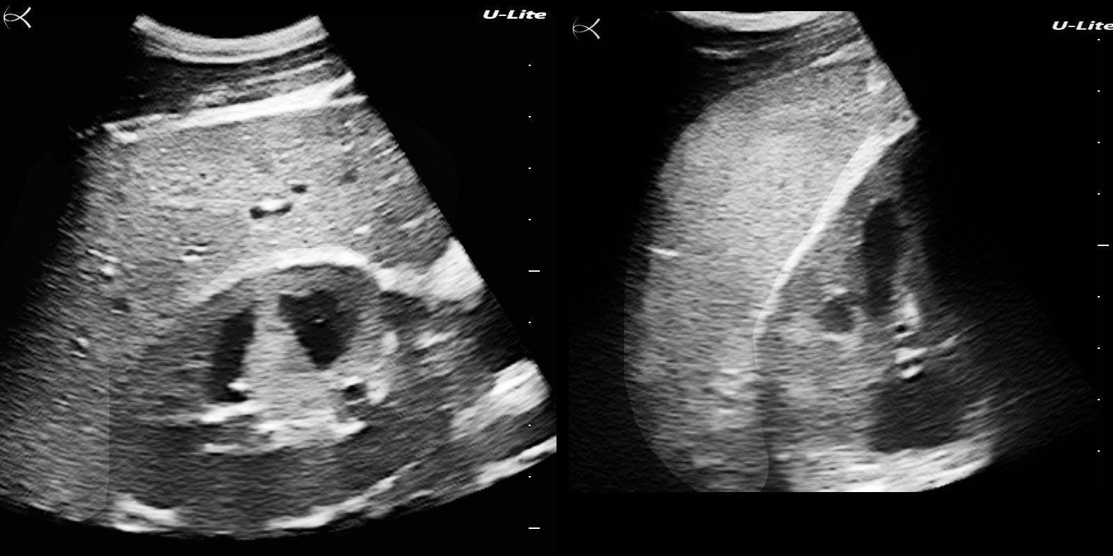 Figure 4. Split-screen view of right and left upper quadrants, mid axillary lines. 