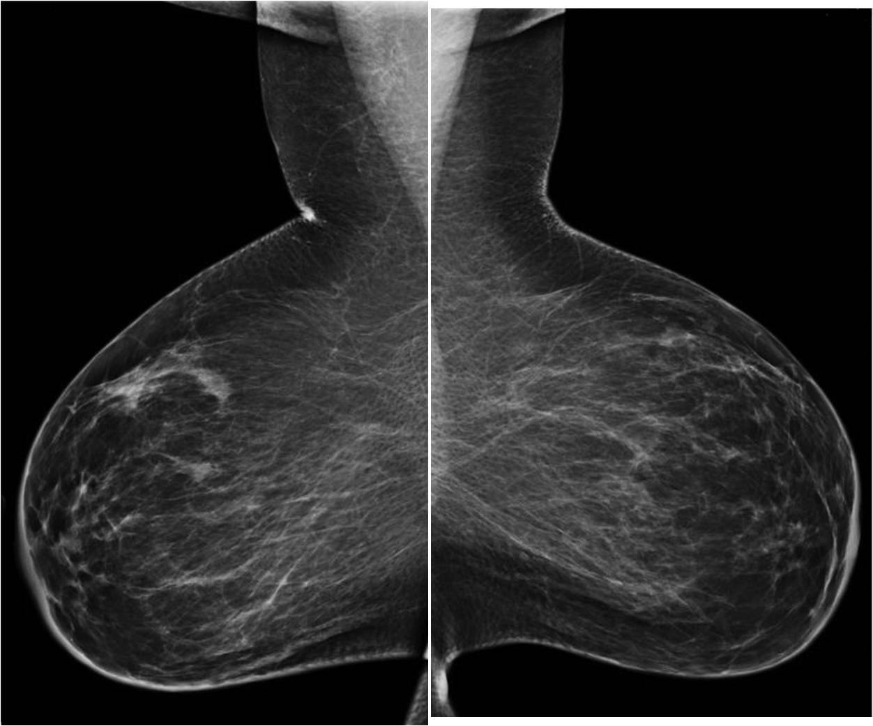 The benefit of a complete breast imaging workup