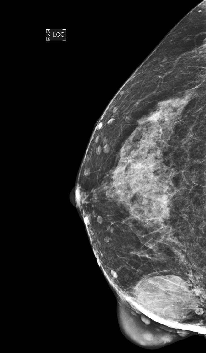 Image IQ: 44-year-old Woman, Screening Mammogram
