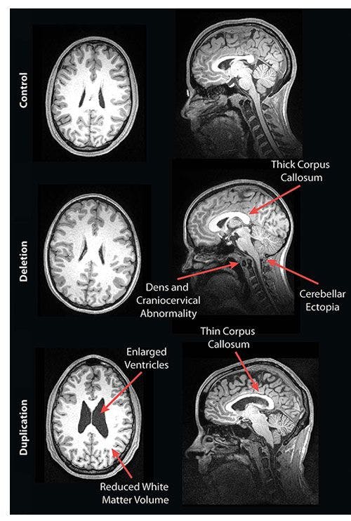 Brain MRI of People with Genetic Autism