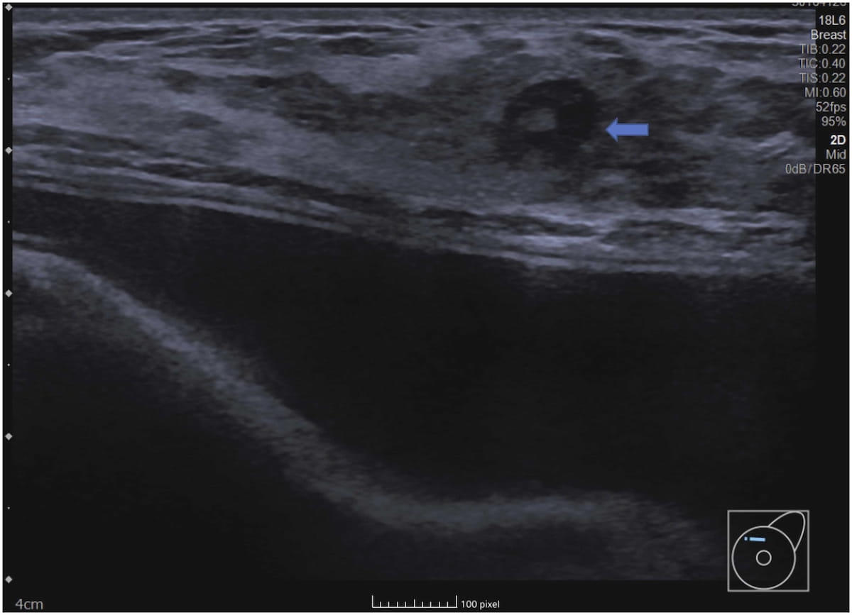 Can AI Rein in Follow-Up Exams and Benign Lesion Biopsies After Breast Ultrasound?