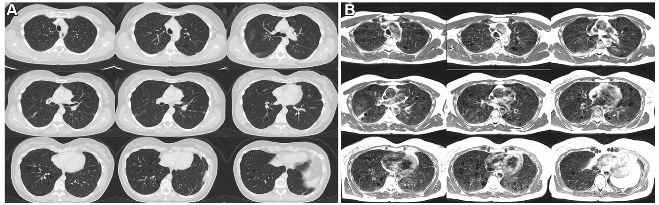Axial multi-section imaging yielded full lung coverage using (A) CT (reformatted to 0.8 × 0.8 × 6 mm) and (B) T2-weighted MRI (1.1 × 1.1 × 6 mm) in a 41-year-old woman with lymphangioleiomyomatosis resulting in innumerable thin-walled pulmonary cysts.

Credit: RSNA