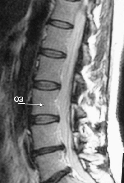 Image-guided spine intervention yields long-term back pain relief