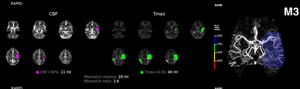 Can Multimodality AI Enhance CT Detection of Medium Vessel Occlusions?