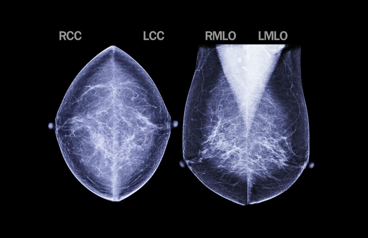 New ACR Guidelines Emphasize Earlier Breast Cancer Screening for High-Risk Women