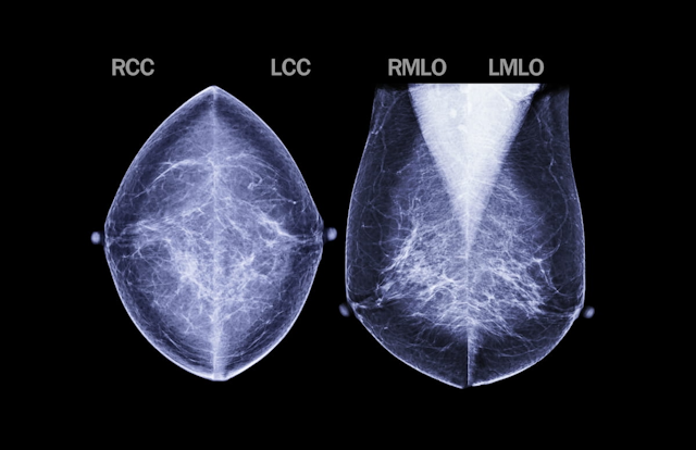 New ACR Guidelines Emphasize Earlier Breast Cancer Screening for High-Risk Women