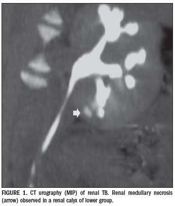 Multislice CT urography characterizes renal TB