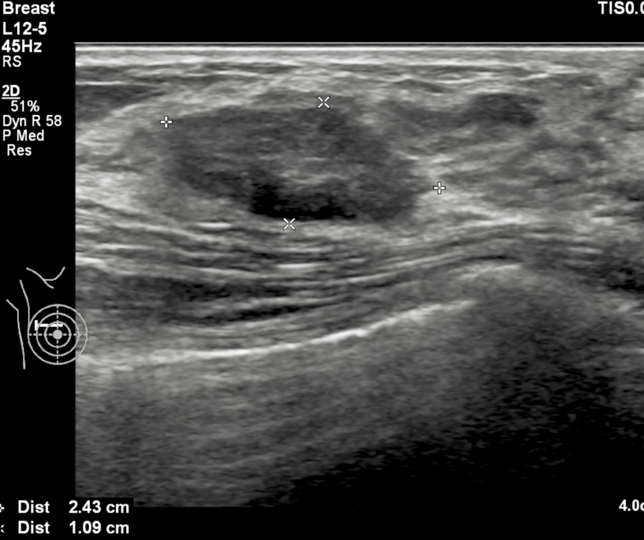 Automated Breast Ultrasound: Is it a Viable Second-Look Option for Women with Dense Breasts?
