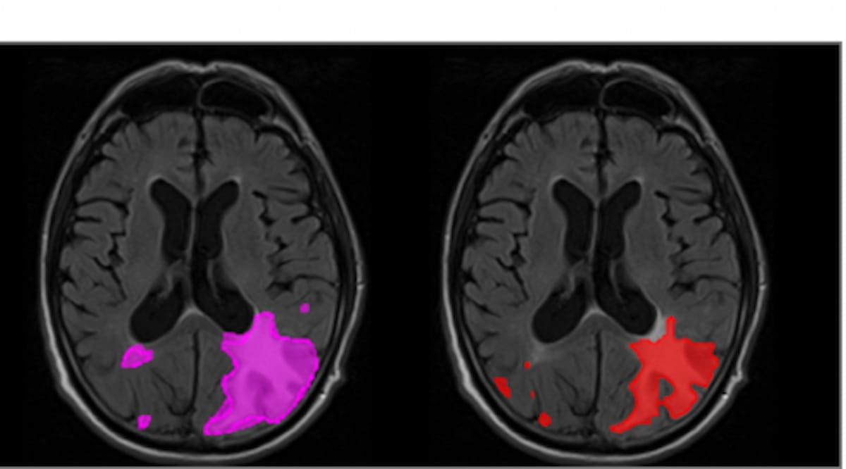 Can AI Enhance MRI Detection of Amyloid-Related Abnormalities in Patients with Alzheimer’s Disease?
