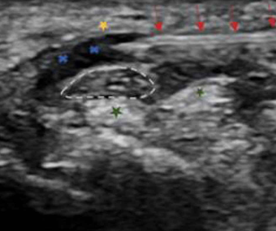 Can Ultrasound-Guided Hydrodissection be a Viable Alternative for Carpal Tunnel Syndrome?