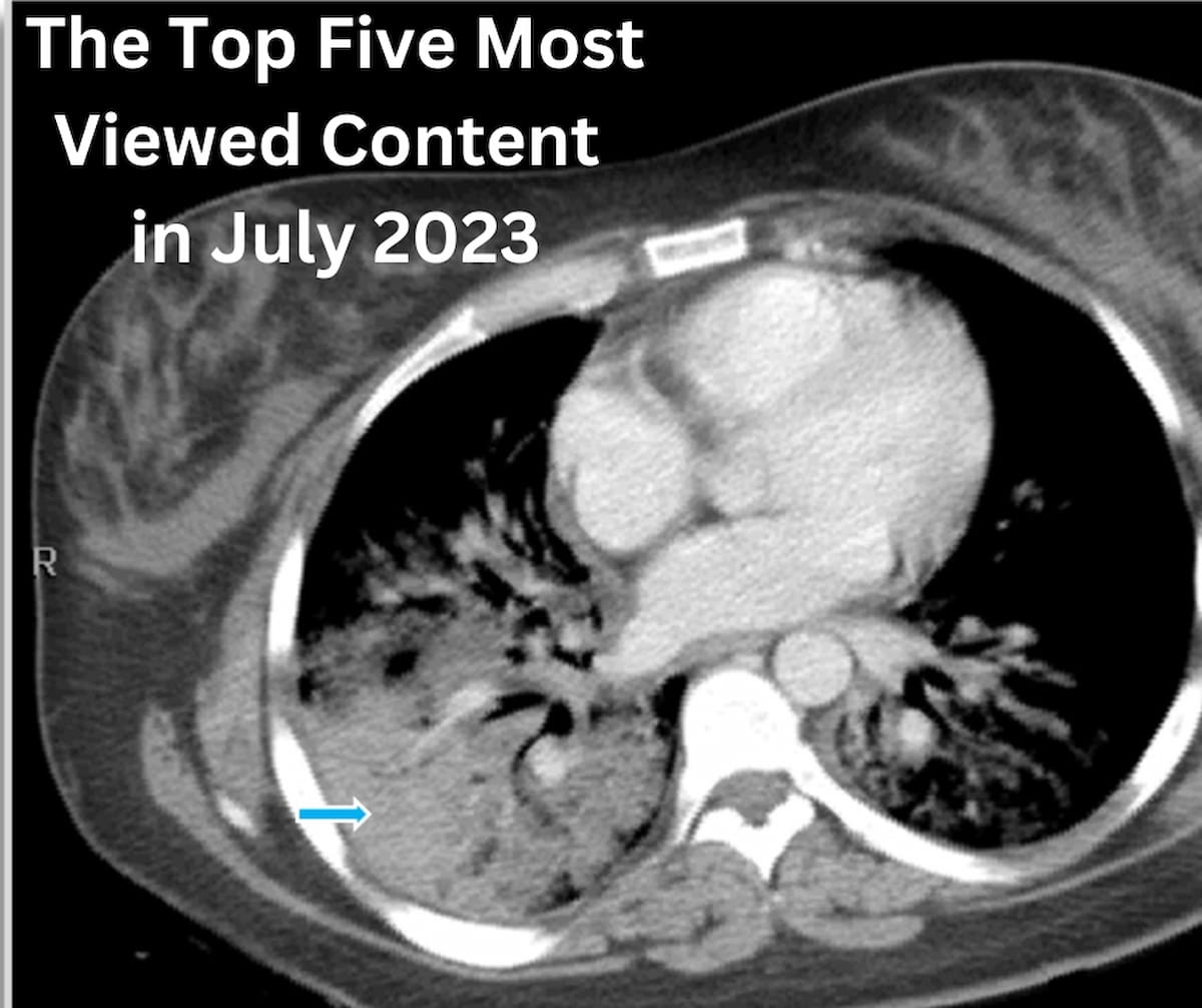 The Top Five Most Viewed Content at Diagnostic Imaging in July 2023