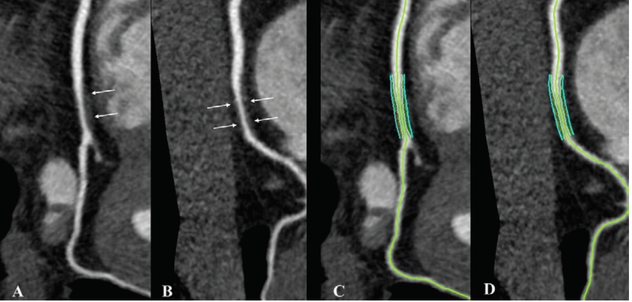 Non-calcified coronary plaque in an asymptomatic 52-year-old man living with HIV with a 10-year Framingham risk of 5 percent. Images show 256-section contrast-enhanced coronary CT angiography with electrocardiographic gating and curve reformat. A, B, CT scan shows a smooth non-calcified plaque in the right coronary artery (arrows) with 70 percent – 80 percent stenosis. C, D, The right coronary artery plaque volume was 130 mm3 (cyan lines).
