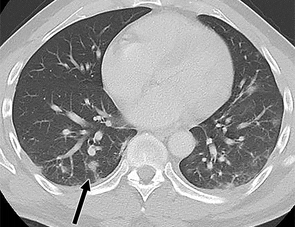 50-year-old man with epigastric and flank pain and diarrhea. Axial CT of abdomen and pelvis shows bilateral peripheral and basilar-predominant ground-glass and nodular opacities (arrow), suggestive of coronavirus disease (COVID-19).  Courtesy: American Journal of Roentgeonology.