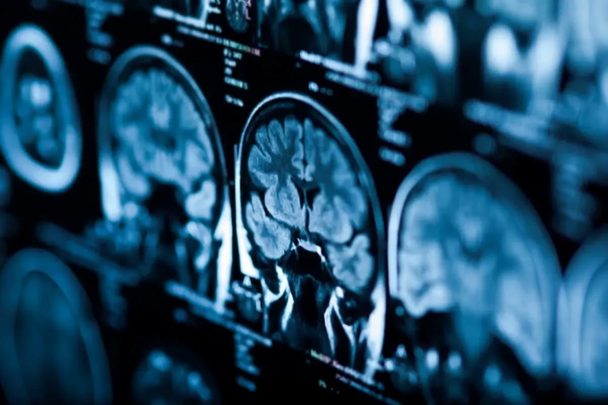 Meta-Analysis of 83 MRI Studies Suggests Link Between Prior Adversity Exposure and Mental Health Issues