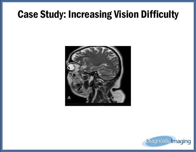 Increasing Vision Difficulty