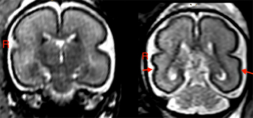 What an MRI Study Reveals About Low Alcohol Use During Pregnancy and Fetal Brain Structure