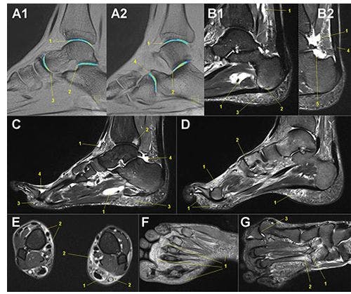 MRI Discovers Cartilage Regeneration in Runners