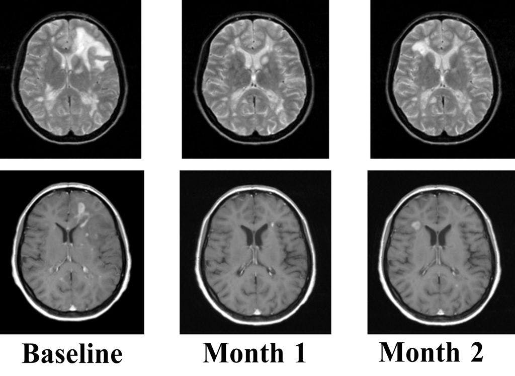 Neuroimaging presentations demonstrate new insights into MS, migraine, and dementia