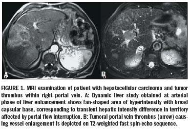 CT and MRI drive awareness of vascular liver disorders