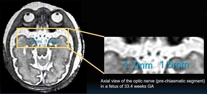 Award-Winning Study Shows Benefits of 3D MRI for Assessing the Fetal Optic Pathway