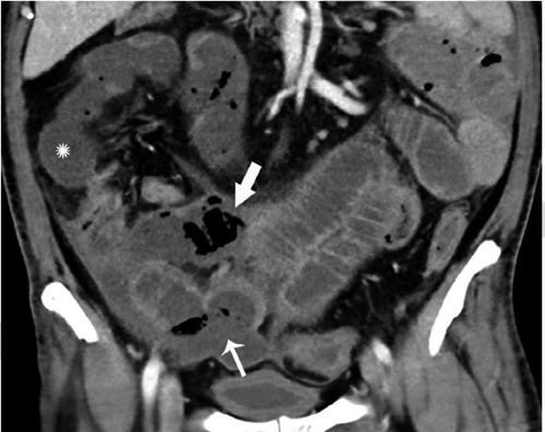 Figure 2a: Coronal (A) CT of the abdomen and pelvis with IV contrast in a 47-year-old man with abdominal tenderness demonstrates typical findings of mesenteric ischemia and infarction, including pneumatosis intestinalis (arrow) and non-enhancing bowel (*). Frank discontinuity of a thickened loop of small bowel in the pelvis (thin arrow) is in keeping with perforation. These findings were confirmed at laparotomy (B), with the additional observation of atypical yellow discoloration of bowel. 