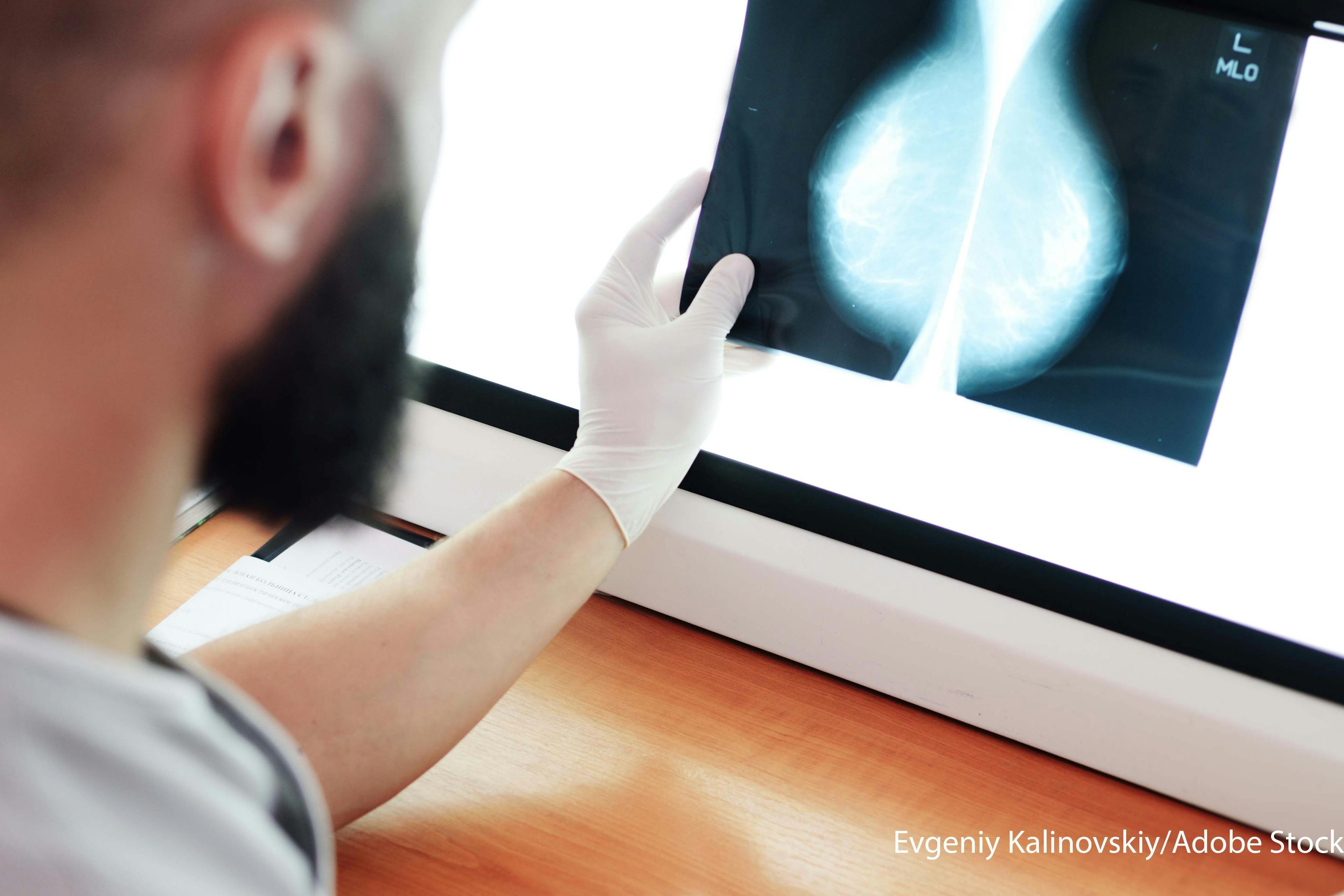 FDA Clears First AI Solution for 2D and 3D Mammography