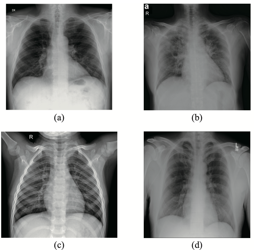 Samples from the dataset used in this study (a) X-ray with PA view of a patient with COVID-19; (b) X-ray with AP view of a patient with COVID-19; (c) X-ray of a healthy patient from Dataset A; (d) X-ray of a healthy patient from Dataset B.