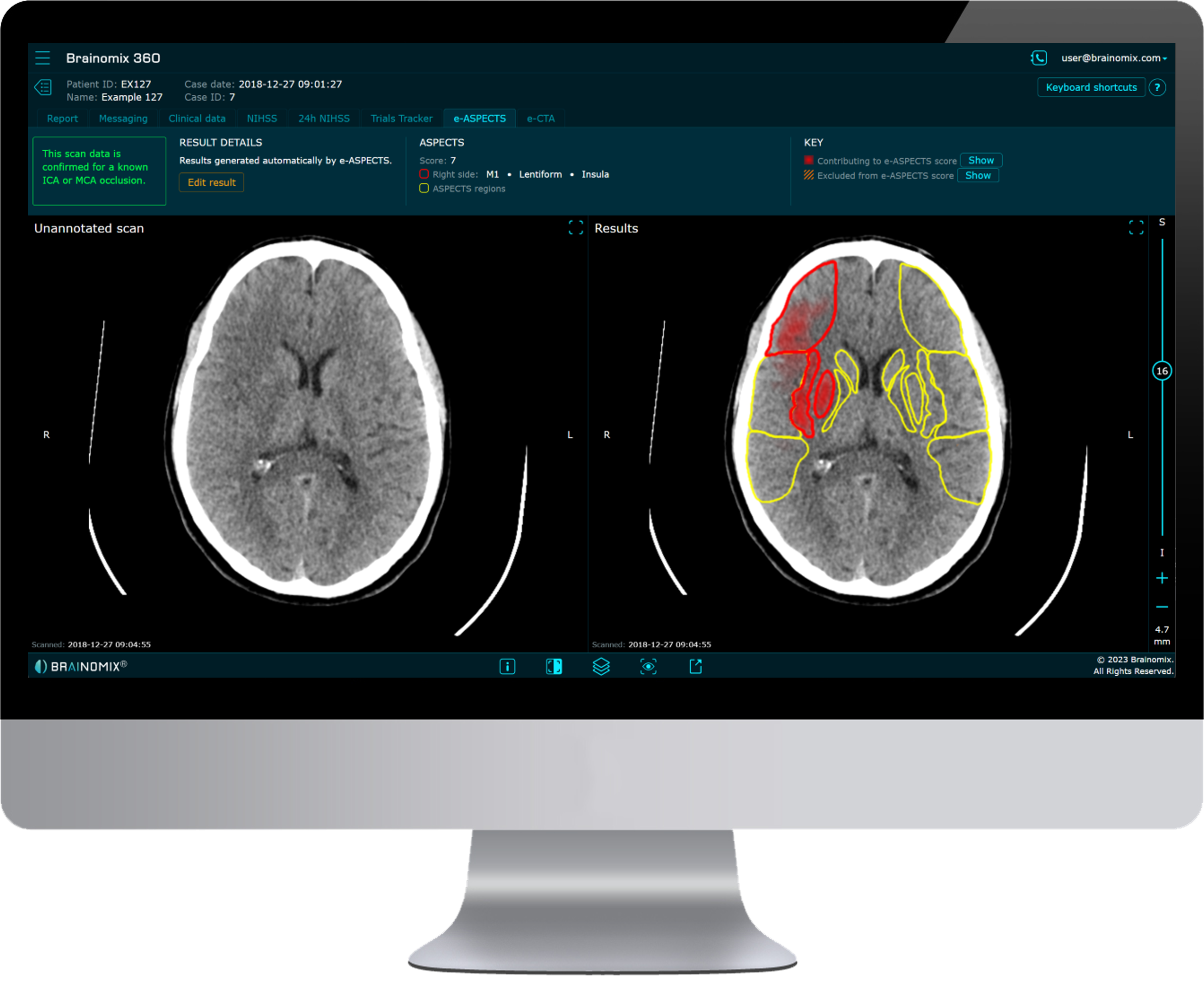FDA Clears AI-Powered Stroke Imaging Tool for Non-Contrast CT