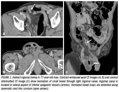 Multidetector CT reveals diverse variety of abdominal hernias