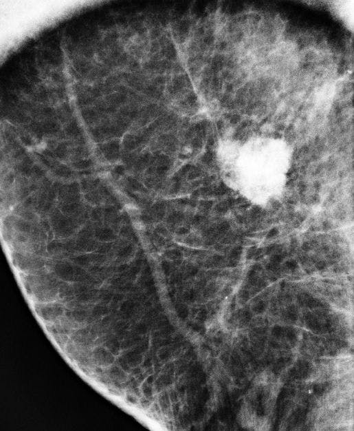 Image IQ: 85-year-old with Family History of Breast Cancer