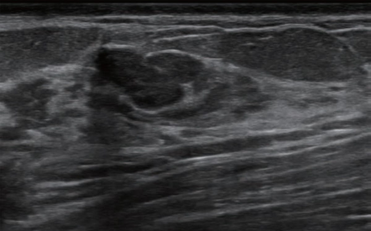 Multicenter Breast Ultrasound Study: AI Bolsters Accuracy and Specificity of BI-RADS Classifications 
