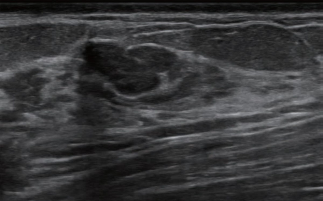 Multicenter Breast Ultrasound Study: AI Bolsters Accuracy and Specificity of BI-RADS Classifications 