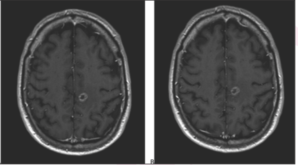 61-year-old man with left hemispheric brain metastasis from lung cancer. Axial T1-weighted MR images obtained using (A) standard-dose gadoterate and (B) reduced-dose gadobutrol 4 days later.

Credit: American Journal of Roentgenology