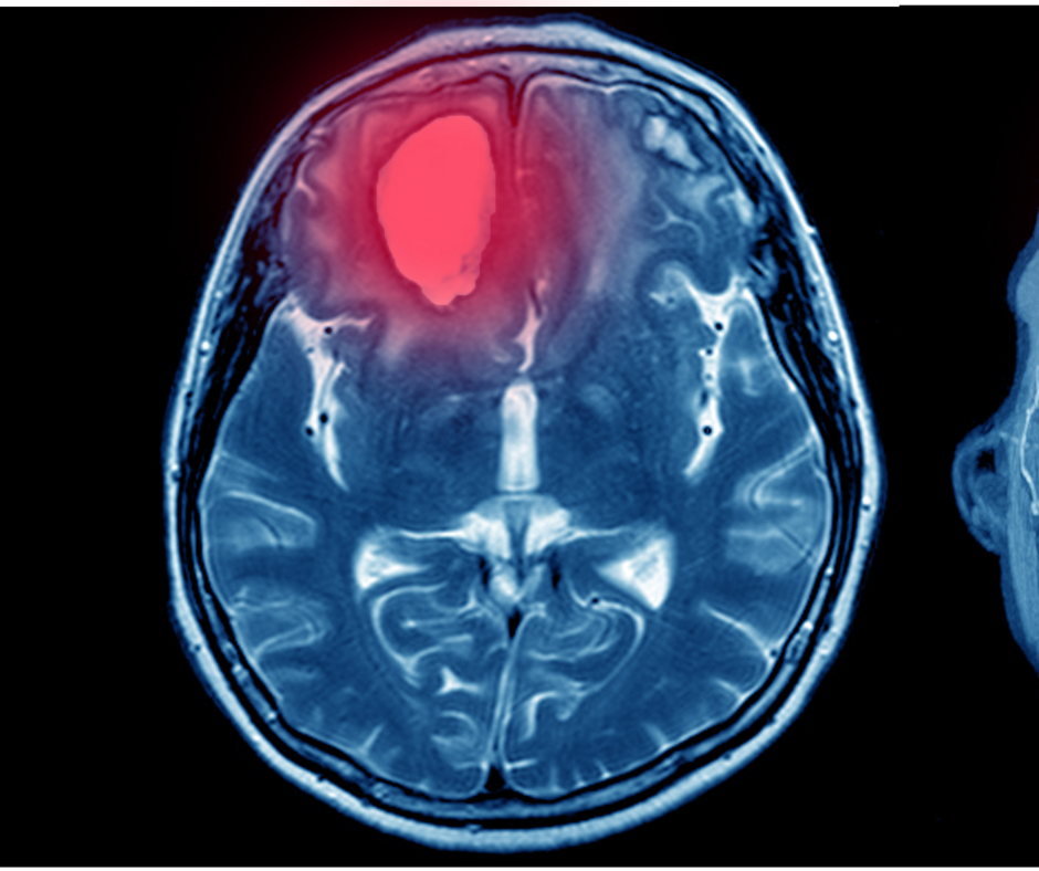 Detecting Intracranial Hemorrhages: Can an Emerging AI Advance Have an Impact?
