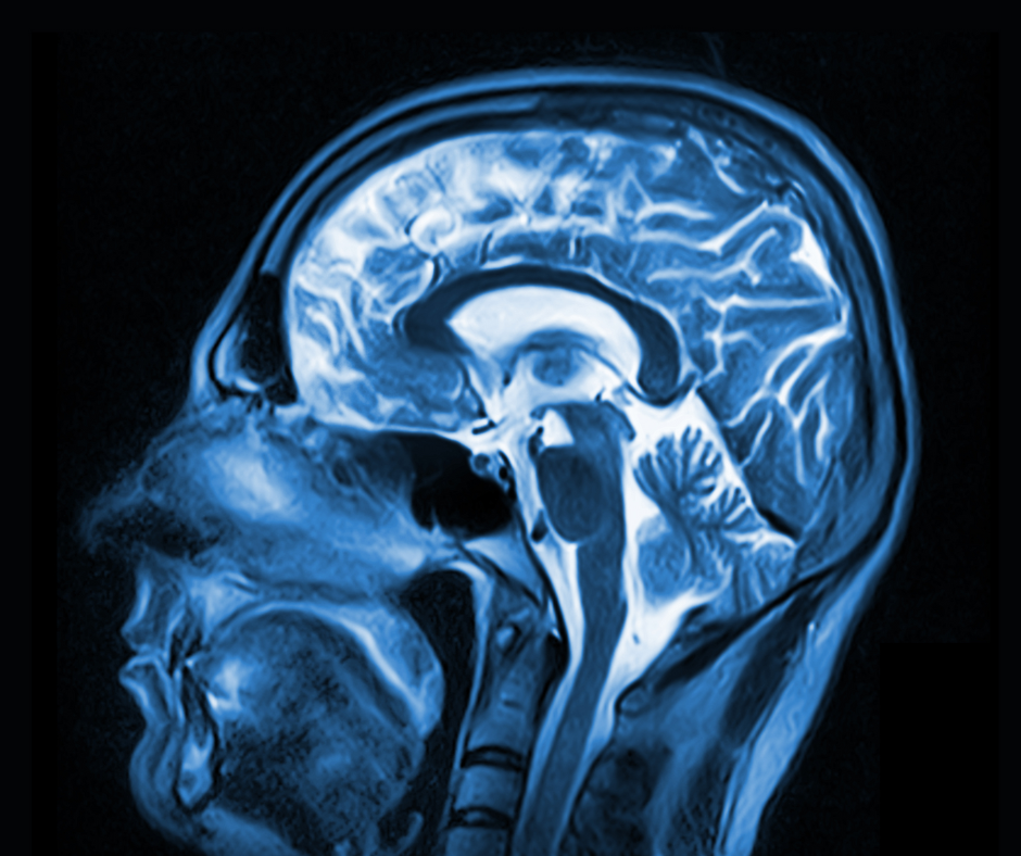 Adjunctive Brain Volume Quantification Tool for MRI Gets FDA Clearance