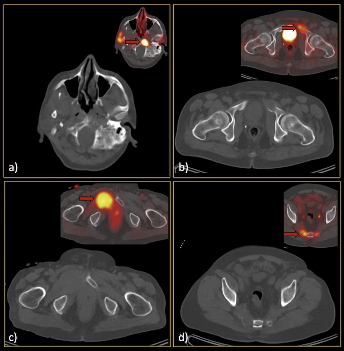 Can Low-Dose CT Have an Impact in Diagnosing Bone Metastasis in Patients with Prostate Cancer?