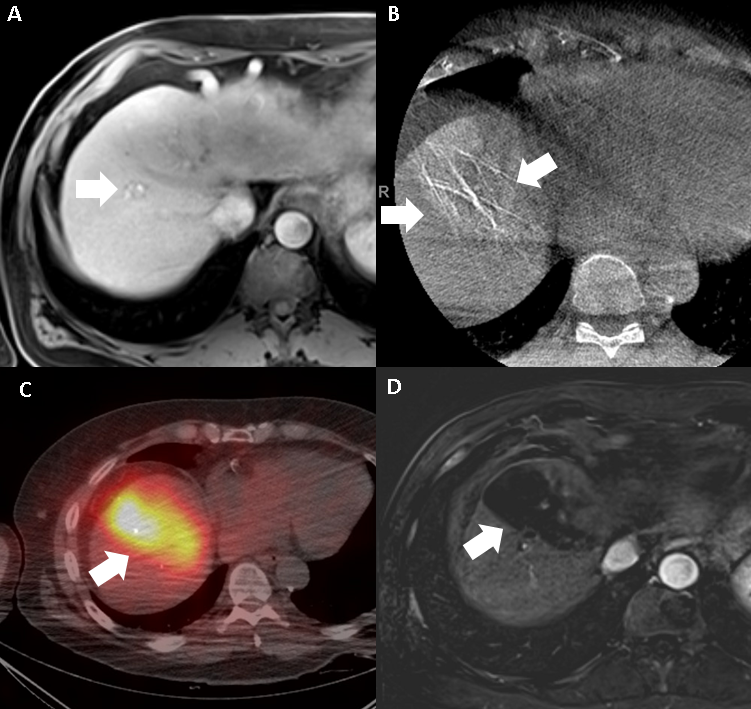 Figure 4. 68-year-old male with cirrhosis and biopsy-proven mixed HCC-cholangiocarcinoma. A) Contrast-enhanced MRI in arterial phase shows the small lesion in segment 8 of the liver (arrow). B) Cone-beam CT obtained during the TARE mapping procedure shows localization of the artery supplying segment 8 (arrows). C) SPECT-CT obtained after TARE shows excellent uptake of the radiation within segment 8 (arrow). D) Subtracted image from a contrast-enhanced MRI in arterial phase obtained approximately three months after TARE shows necrosis of segment 8 without residual disease (arrow).
