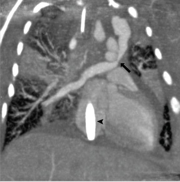 Supracardiac Total Anomalous Pulmonary Venous Return (TAPVR)