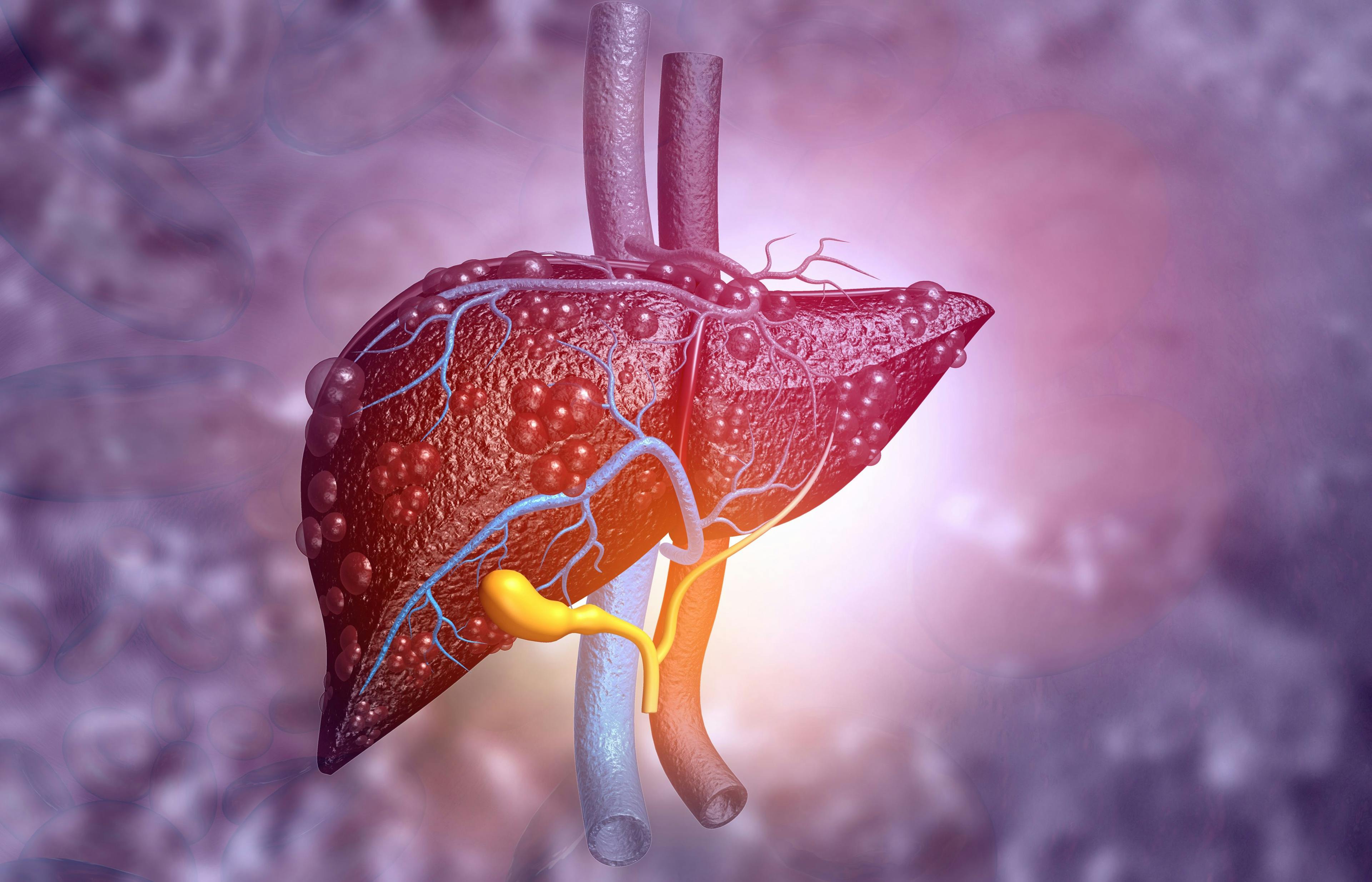 Early PET/CT Can Help Predict Treatment Response, Survival of Patients with Liver Cancer