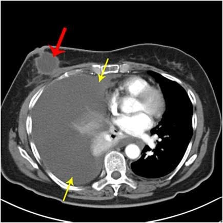 Invasive Ductal Carcinoma with Tumor Necrosis